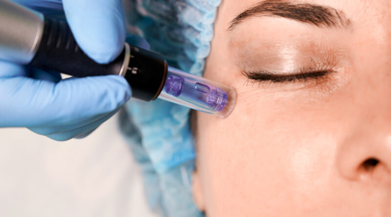 Laser Skin Resurfacing Options for McMinnville Residents 08_20